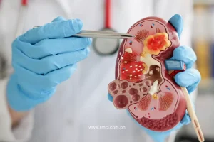 chronic-kidney-disease-davao-panabo-city