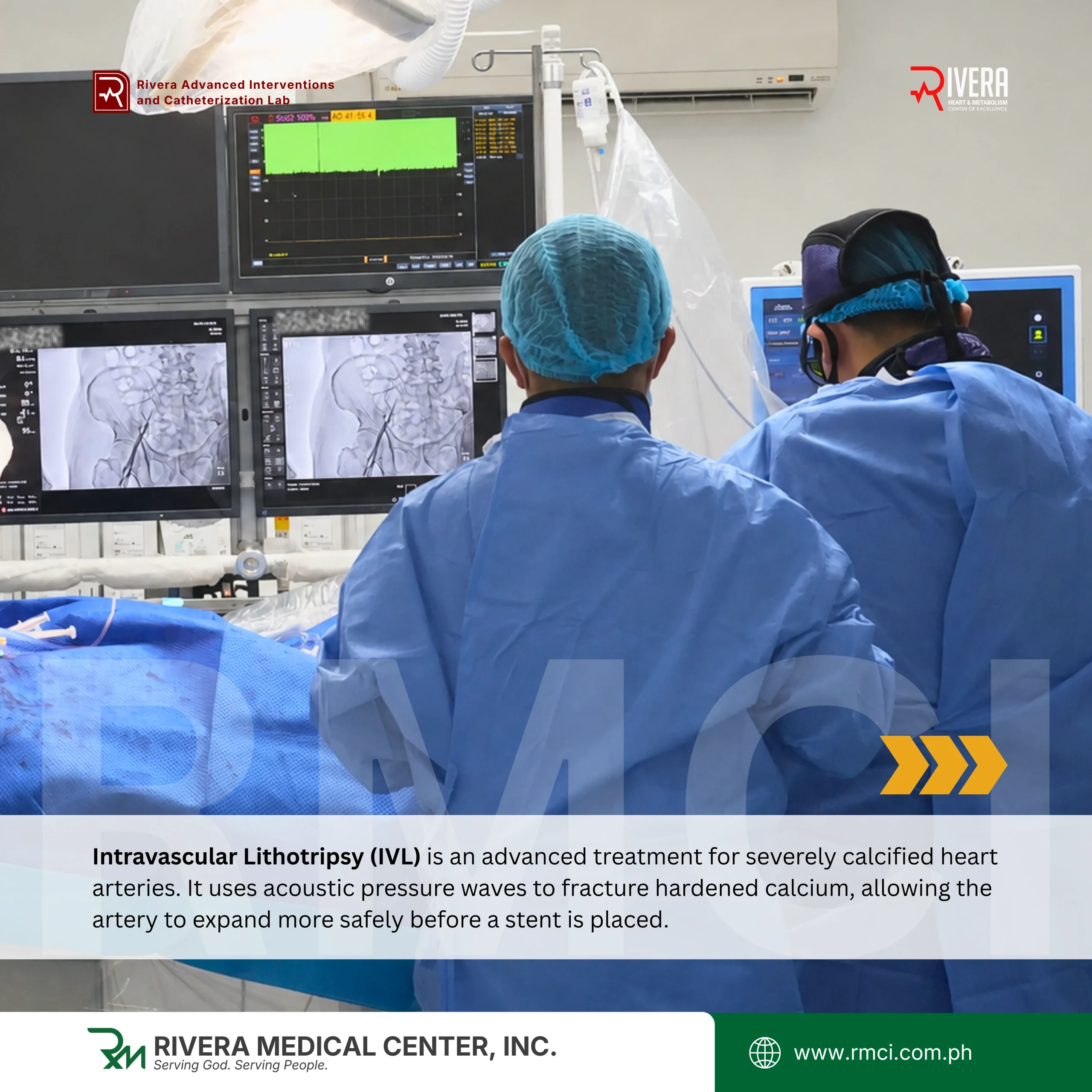 The first successful coronary Intravascular Lithotripsy (IVL) procedure in Mindanao