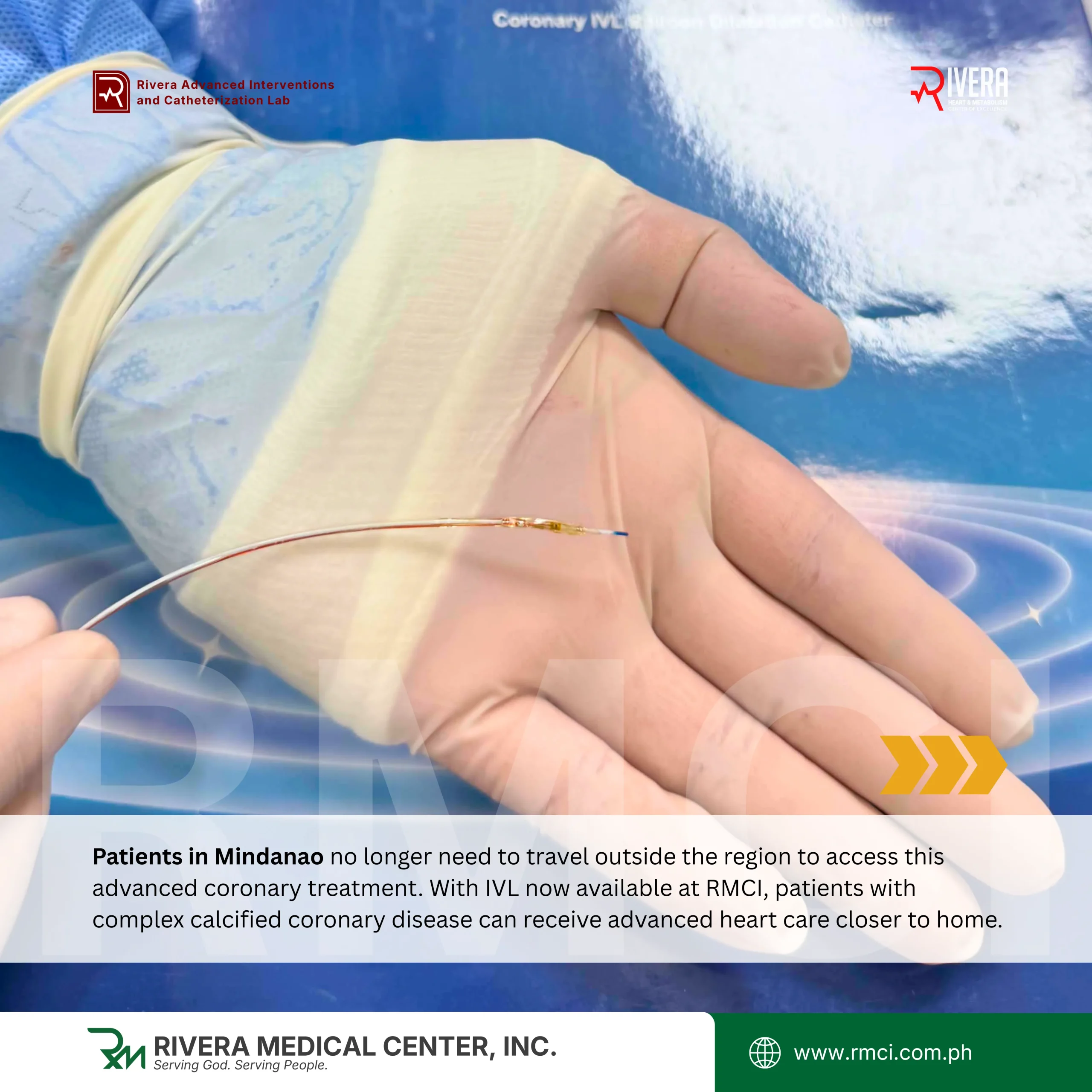 The first successful coronary Intravascular Lithotripsy (IVL) procedure in Mindanao