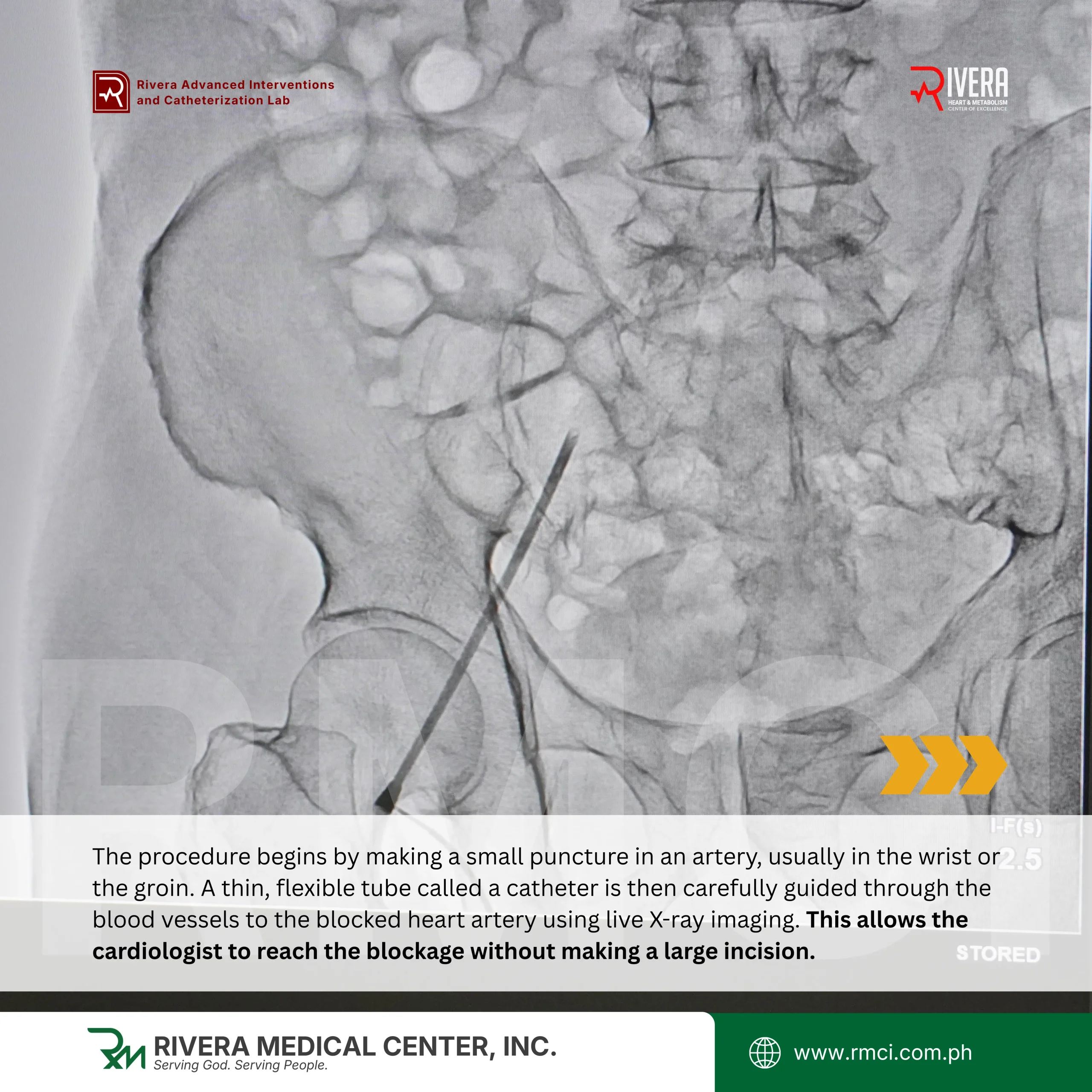 The first successful coronary Intravascular Lithotripsy (IVL) procedure in Mindanao