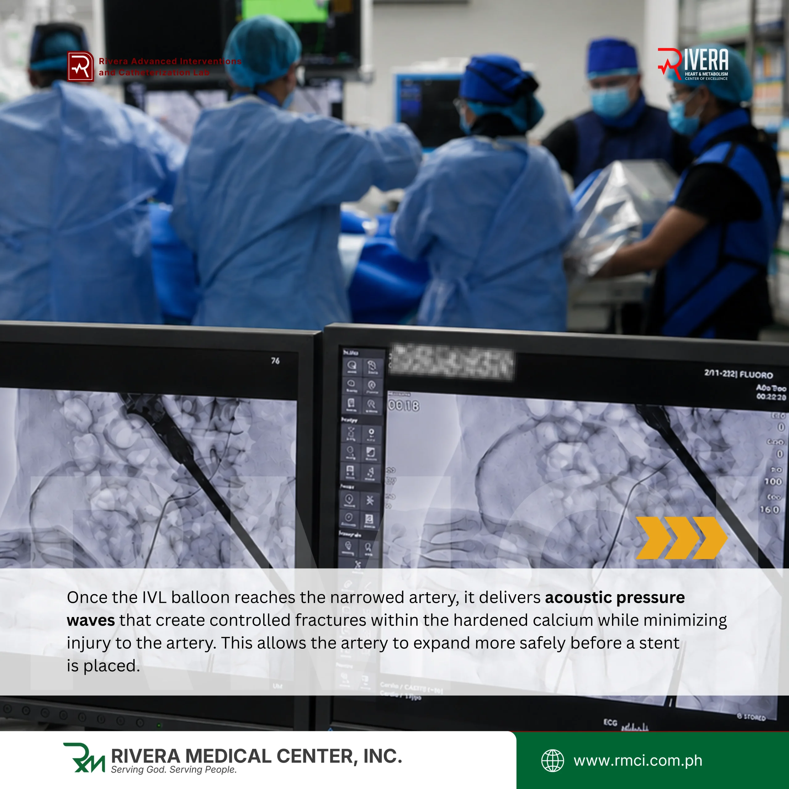 The first successful coronary Intravascular Lithotripsy (IVL) procedure in Mindanao